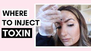 Botulinum Toxin Injection Points | Korean Toxin Dilution & How To Inject Ft. @TheDIYBeautyLab