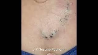 Popping huge blackheads and Giant Pimples - Best Pimple Popping Videos #167