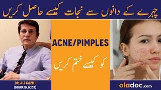 Acne Treatment - Chehre Ke Dano Asan Ka Ilaj - How To Get Rid Of Pimples - Acne Scars Removal