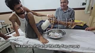 ilizarov treatment in tibia fibula fracture skin flap surgery asam guwahati se ilaj karane aaya