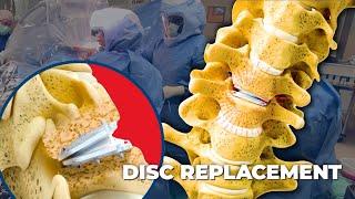 Spinal Disc Replacement: Life Without Back Pain?