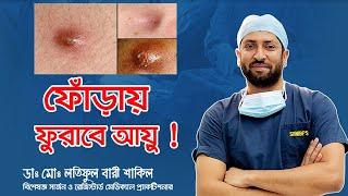 শরীরে ফোঁড়া (Abscess) হলে বা পুঁজ জমলে কী করণীয় ? । Md Latiful Bari