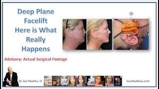 Deep Plane Facelift:  What Really Happens