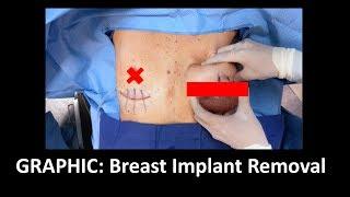 GRAPHIC: En Bloc Capsulectomy Implant Removal w/ Explanation