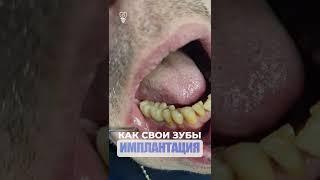 Как свои зубы. Identical teeth. Implantation.