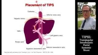 TIPSS by Dr. Robert Gish