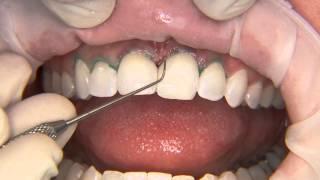 Direct Resin Veneers - A Great Practice Builder! (Item# V1559)