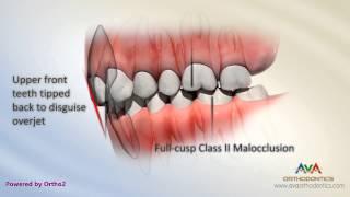 Malocclusion - Class II Div 2