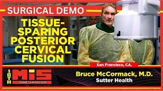 Tissue Sparing Posterior Cervical Fusion - Bruce McCormack, M.D.