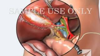 Gallbladder Removal Surgery (Laparoscopic Cholecystectomy)
