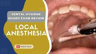 NBDHE - DENTAL HYGIENE BOARD EXAM REVIEW: Everything you need to know about Local Anesthesia