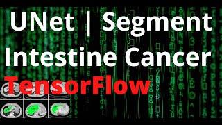 UNet with TensorFlow - Segment Intestine Cancer  | Kaggle | Deep Learning | Computer Vision