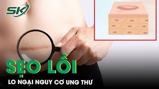 Lo Ngại Nguy Cơ Ung Thư Từ Vết Sẹo Lồi | SKĐS