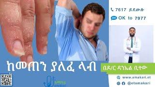 ከመጠን ያለፈ ላብ መንስኤዎች፤ ምልክቶች፣ ምርመራ እና ህክምና