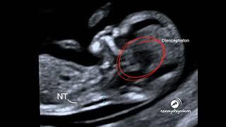 Nuchal Translucency