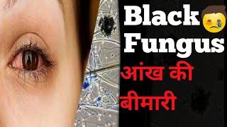 Black Fungus Aankh ki bimari kaise ho raha or Isse kaise  bache Yt shorts information Gyan Warriors