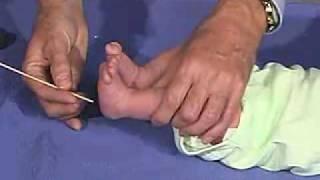 physical exam -Newborn Normal: Reflexes - Plantar Reflex