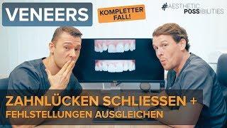 Zahnlücken und Fehlstellungen mit Veneers ausgleichen - So funktioniert es!