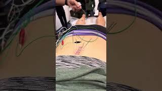 Setting up electroacupuncture for fibromyalgia