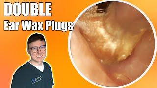 “Unbelievable difference!” | Hearing TRANSFORMED after removing two plugs  - Ear Wax Removal Ep. 10