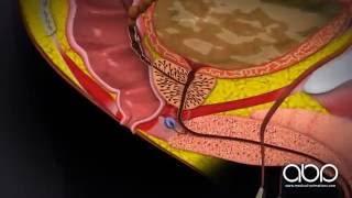 Prostate Cancer (Labelled) - 3D Medical Animation || ABP ©