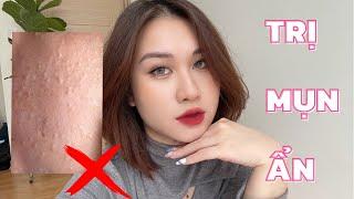 TRỊ MỤN ẨN TRIỆT ĐỂ | HÀNH TRÌNH GIAN NAN NHƯNG CHẮC CHẮN SẼ HẾT!! | CHLOE DO