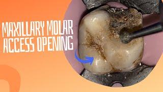 Access Opening on a Heavily Restored Maxillary Molar