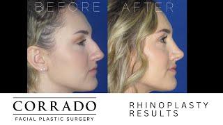 Nose Job Patient Experience | Dr. Anthony Corrado