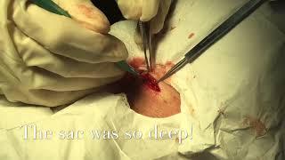 Excision and Drainage of a cyst on the back at Coastal Dermatology and Medspa