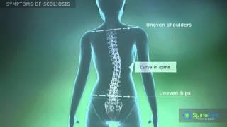 Scоliosis Symptoms