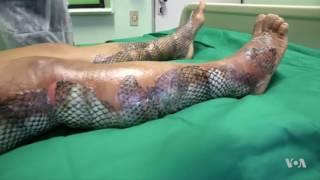 Alternative Therapy Uses Fish Skin for Burn Relief