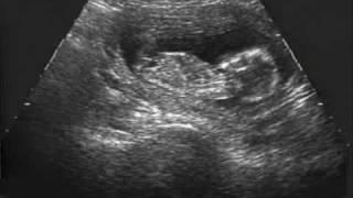 Alcohol  Damages Unborn Baby