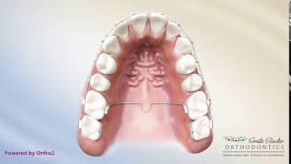 Orthodontic Appliance -  TPA (Trans Palatal Arch)