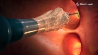 Medtronic Arctic Front Advance Cryoballoon Animation