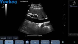 YOUKEY Wireless Ultrasound clinical images