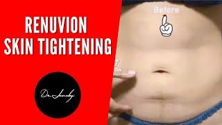 Renuvion skin tightening ! Before & After drjeneby