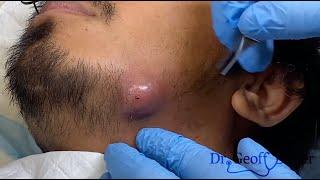 Infected Cyst Drainage on Jawline