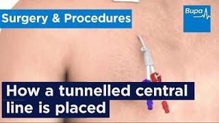 How a tunnelled central line is placed | Bupa Health