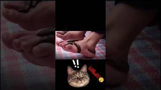 Leech Therapy! #youtubeshorts #viral #amazingfacts #amazing