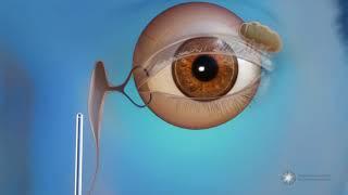 What is endoscopic dacryocystorhinostomy (DCR) surgery for blocked tear ducts?