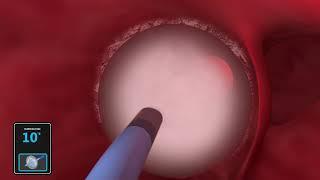 Animation of Polarx Ablation for AF