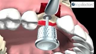 Implantes dentales: qué son, tratamiento y mantenimiento