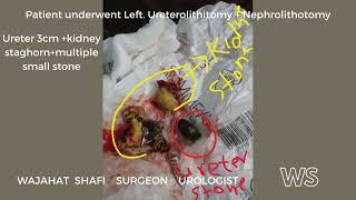 Bilateral  Kidney stones (Staghorn stones+ ureter stone )