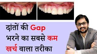 दांतों की Gap भरने का सबसे कम खर्च वाला तरीका - by Dr Ankit Khasgiwala | SERAPHIC DENTAL | INDORE