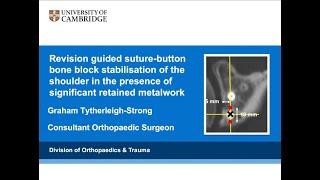 Rocky Mountain Shoulder 2024: Revision Suture-Button Bone Block Stabilisation