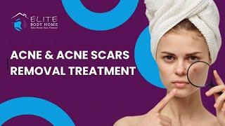 Acne & Acne Scars Treatment at Elite Body Home