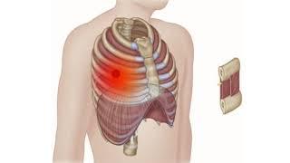 Intercostal Muscles | Chest Pain | Rib Pain | Trigger Points