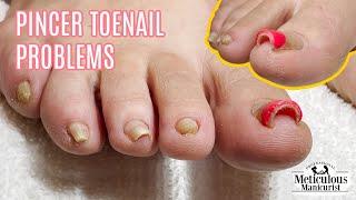 Pedicure Tutorial on Pincer Toenails that Cause Pain