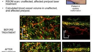 3D Imaging Of Vascular Anomalies Using Raster-Scanning Optoacoustic Mesoscopy