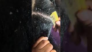 REUPLOAD DANDRUFF SCRATCHING